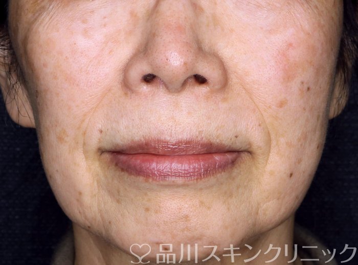 症例NO.70645のBEFORE写真