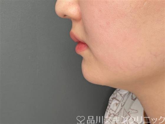 症例NO.60250のBEFORE写真