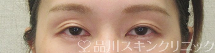 症例NO.75160のAFTER写真