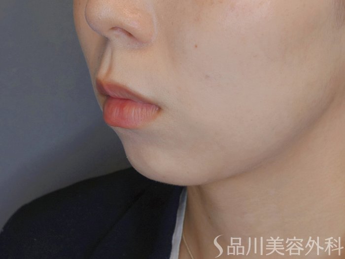症例NO.74105のBEFORE写真