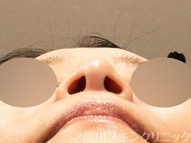 症例NO.68927のAFTER写真