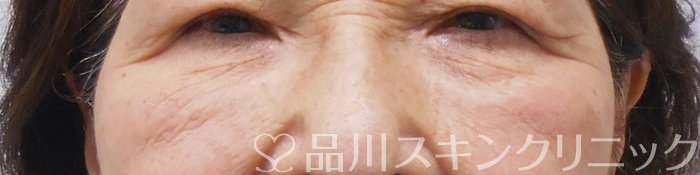 症例NO.70023のBEFORE写真
