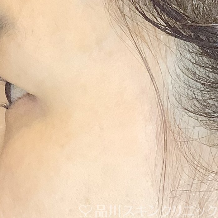 症例NO.65509のAFTER写真