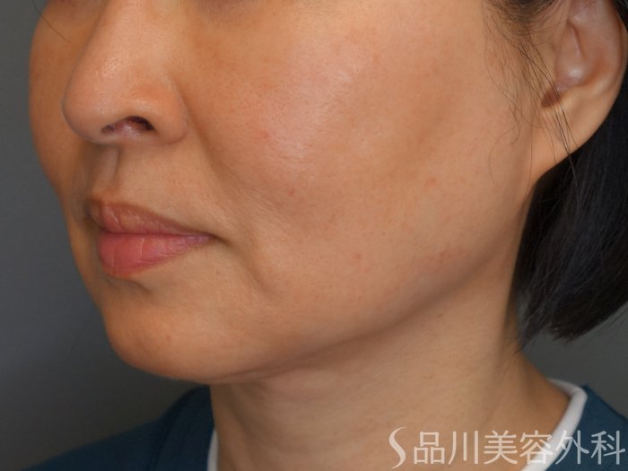 症例NO.70074のBEFORE写真
