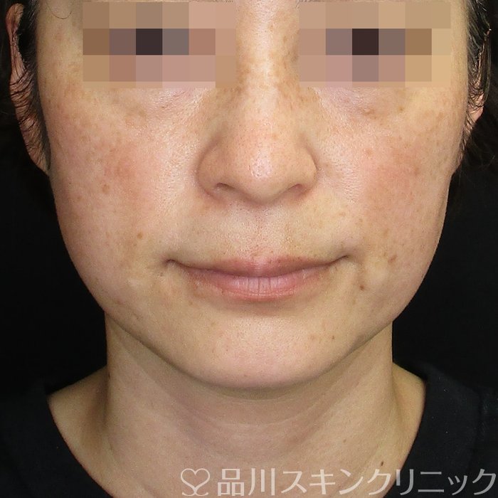 症例NO.75212のAFTER写真