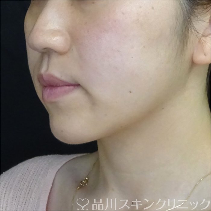 症例NO.69907のAFTER写真