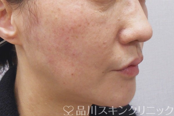 症例NO.69671のAFTER写真