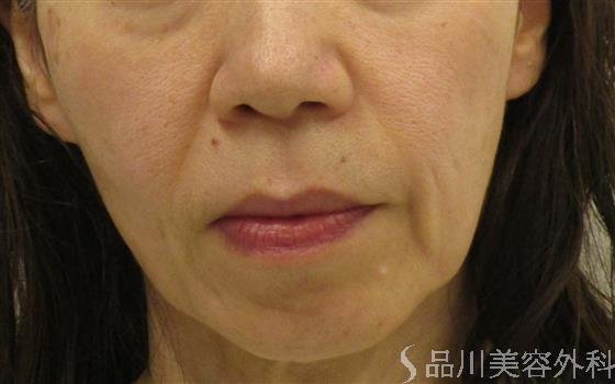 症例NO.57647のBEFORE写真