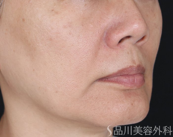 症例NO.71386のBEFORE写真