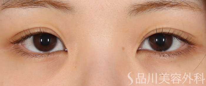 症例NO.72830のBEFORE写真