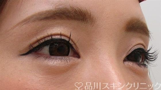 症例NO.41724のAFTER写真