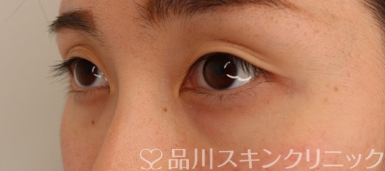 症例NO.74070のBEFORE写真