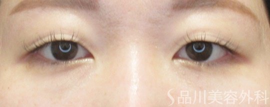 症例NO.69429のBEFORE写真