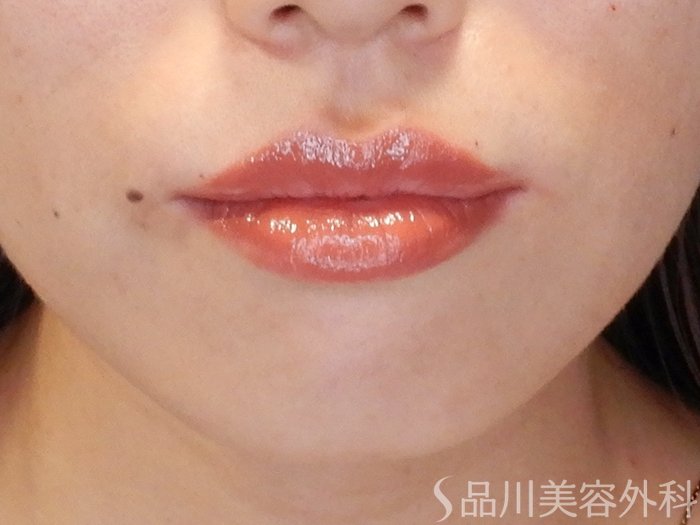 症例NO.65348のAFTER写真