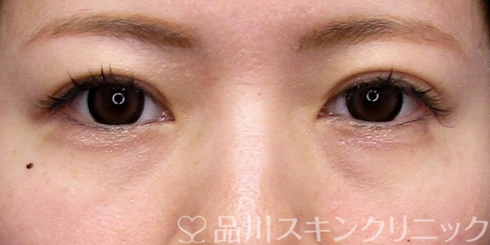 症例NO.74832のBEFORE写真
