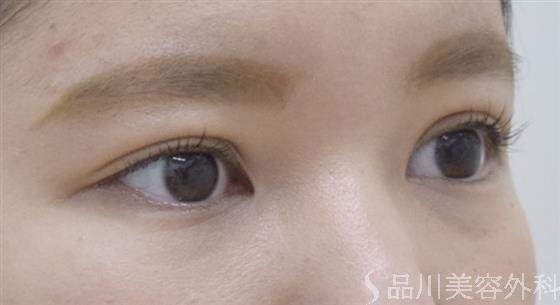 症例NO.52539のAFTER写真