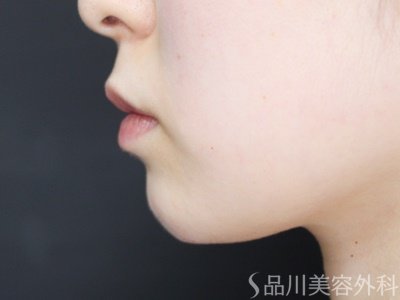 症例NO.69636のAFTER写真