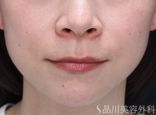 症例NO.69674のAFTER写真