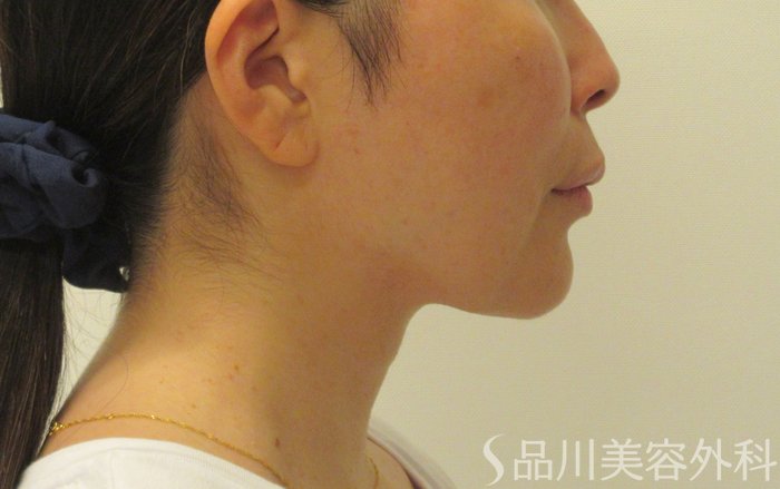 症例NO.71760のAFTER写真