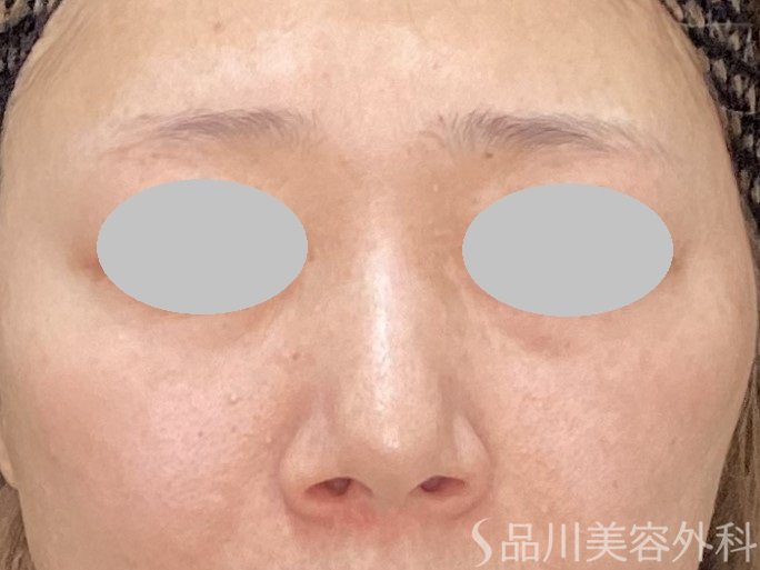 症例NO.73183のBEFORE写真