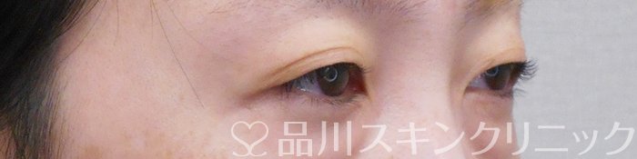 症例NO.74517のBEFORE写真