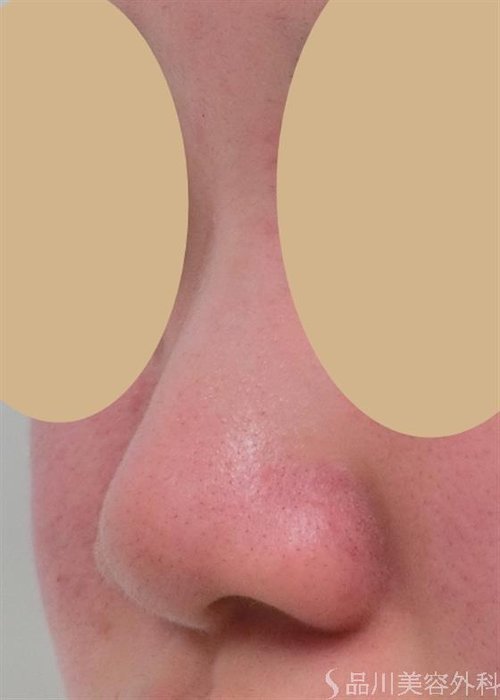 症例NO.27814のBEFORE写真