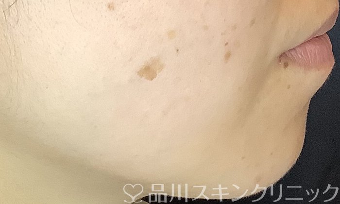 症例NO.73743のBEFORE写真