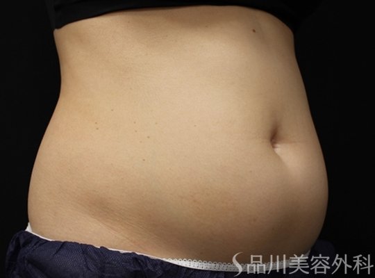 症例NO.75139のBEFORE写真