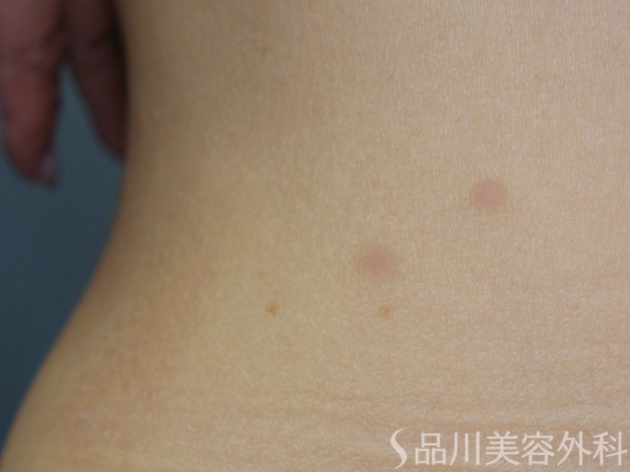 症例NO.73544のAFTER写真