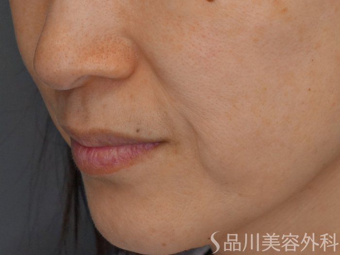 症例NO.71860のBEFORE写真