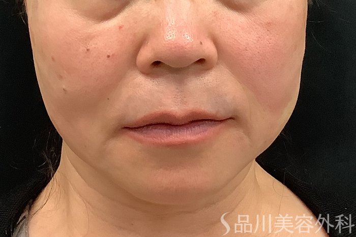 症例NO.73321のAFTER写真