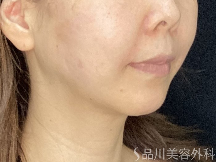 症例NO.71785のAFTER写真