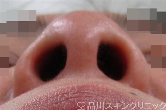 症例NO.34505のBEFORE写真