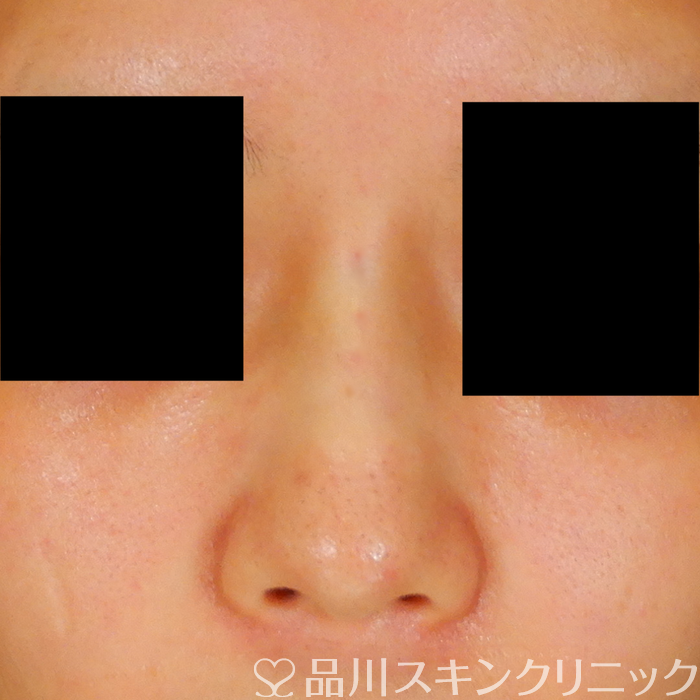症例NO.63190のAFTER写真