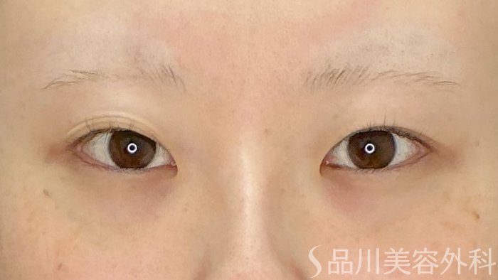 症例NO.71761のBEFORE写真