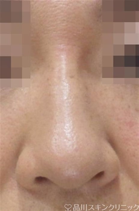症例NO.35124のAFTER写真