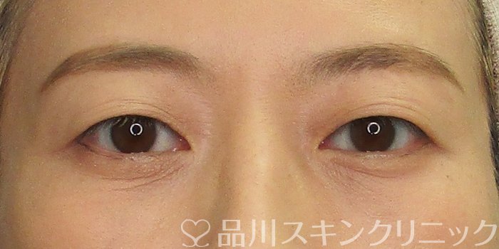 症例NO.70479のAFTER写真
