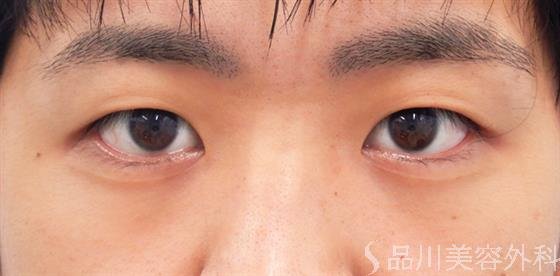 症例NO.52391のBEFORE写真