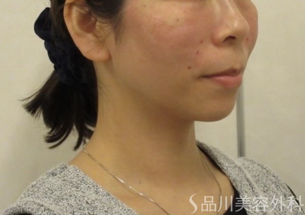 症例NO.73554のAFTER写真