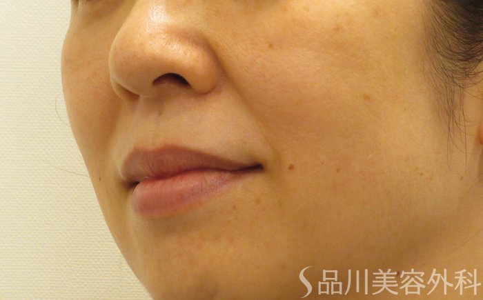症例NO.70395のBEFORE写真