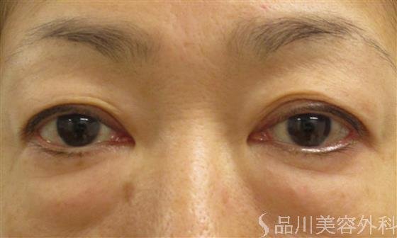 症例NO.50168のBEFORE写真