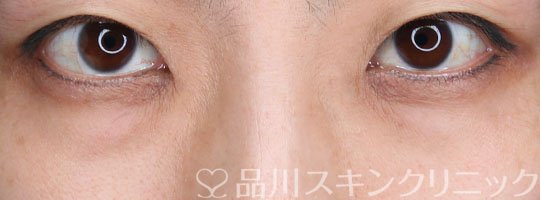 症例NO.74425のBEFORE写真