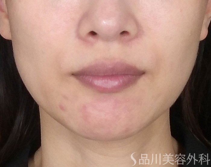 症例NO.65137のBEFORE写真