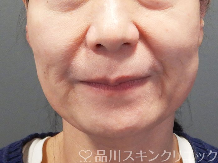 症例NO.73523のBEFORE写真