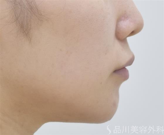 症例NO.44615のBEFORE写真