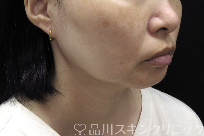 症例NO.74421のBEFORE写真