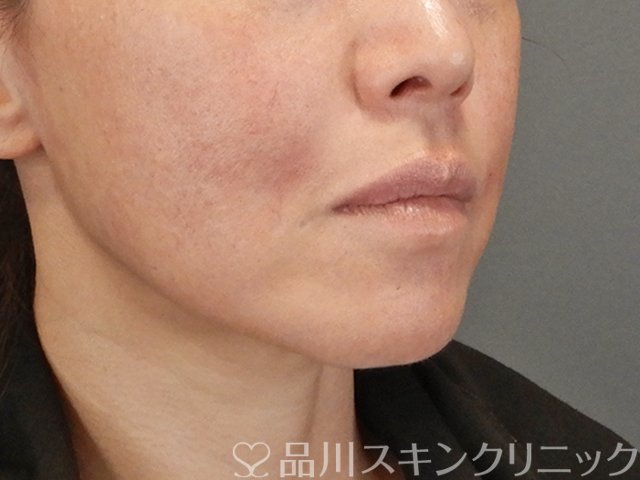 症例NO.75298のAFTER写真