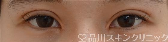 症例NO.46502のAFTER写真