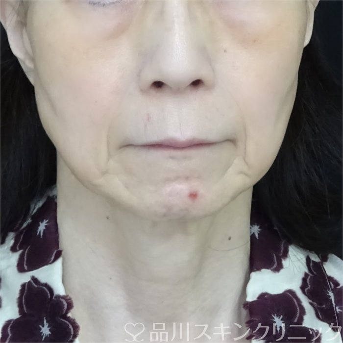 症例NO.70611のBEFORE写真