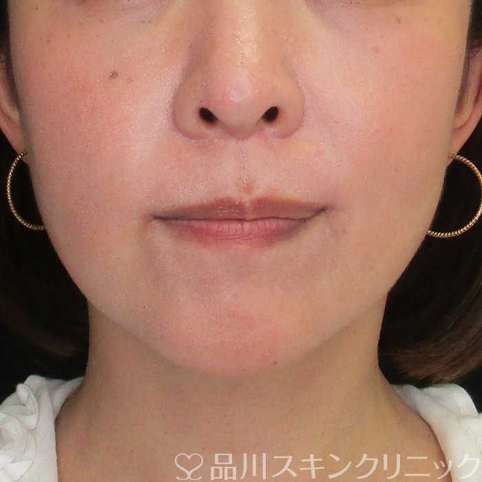 症例NO.74394のBEFORE写真
